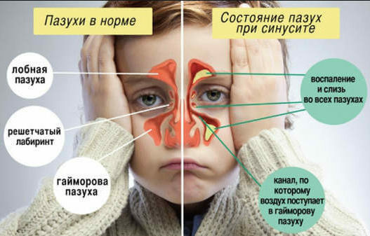Как лечить желтые сопли у ребенка