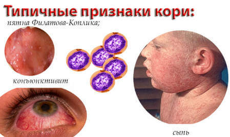 конъюнктивит при кори у детей